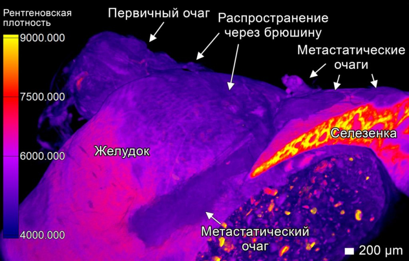 Рак распространяется как сеть: российские ученые наблюдали в 3D особенности развития опухолей